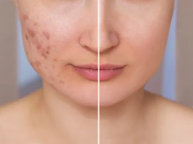 before-after-acne-treatment